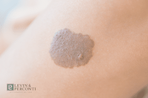 Misshapen mole on someone's arm that could be melanoma
